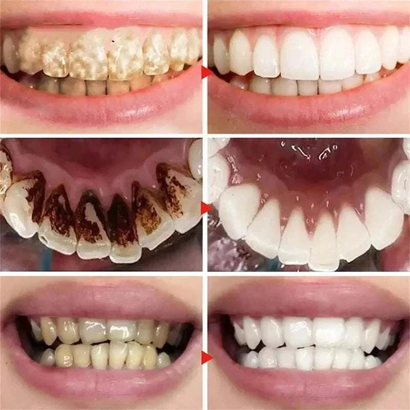 Comparison of stained, yellowed teeth before and after using 5D Teeth Whitening Stick showing significantly whiter, brighter teeth and improved oral cleanliness