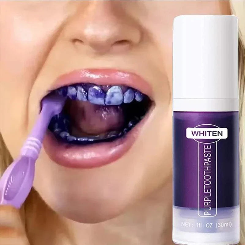 5D Teeth Whitening Stick with purple toothpaste applied inside mouth for deep stain removal and teeth brightening
