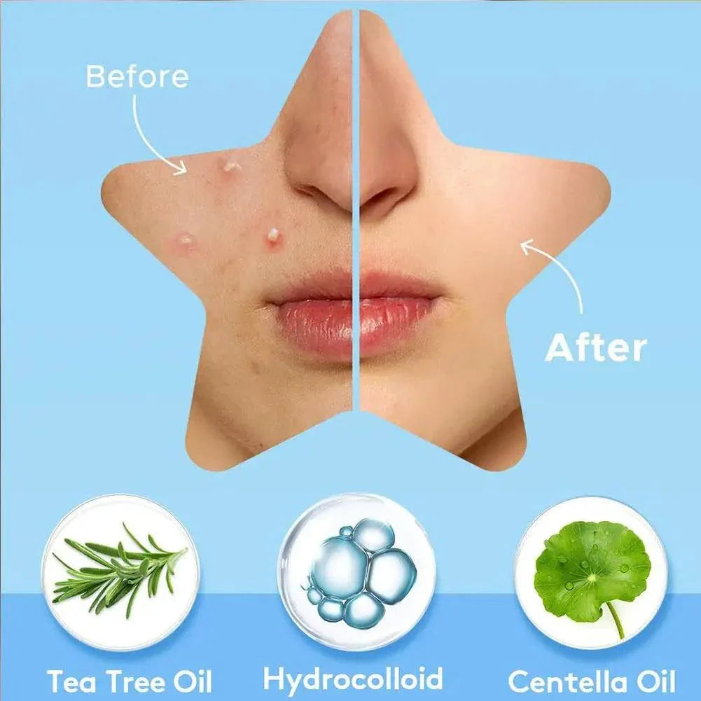 Before and after close-up of cheek showing acne improvement using Colorful Star Pimple Patch with tea tree oil, hydrocolloid, and centella oil benefits.