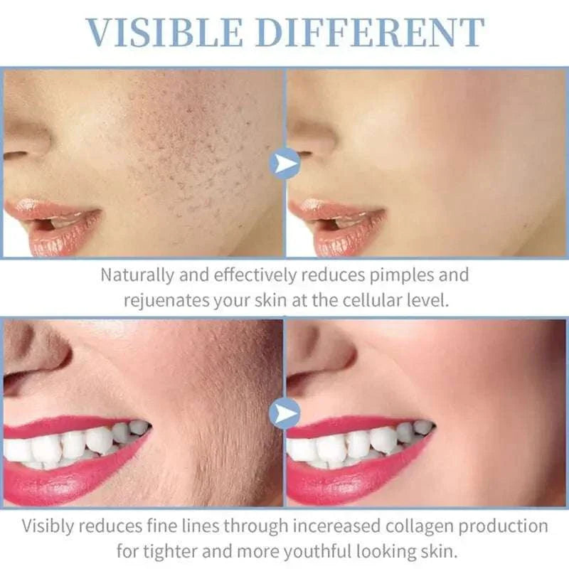 Before and after images showing the effects of 4-in-1 Handheld Electric Facial Therapy Wand reducing pimples and fine lines for rejuvenated, smoother skin.