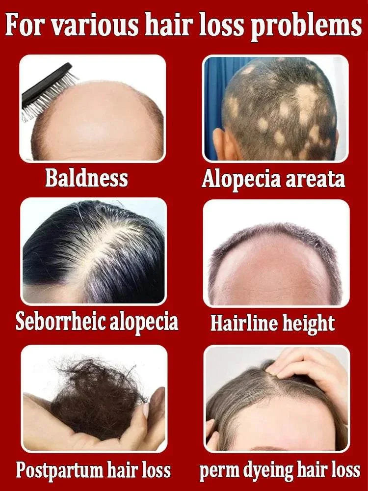 Hair Growth Treatment for baldness, alopecia areata, seborrheic alopecia, hairline height, postpartum hair loss, and perm dyeing hair loss problems