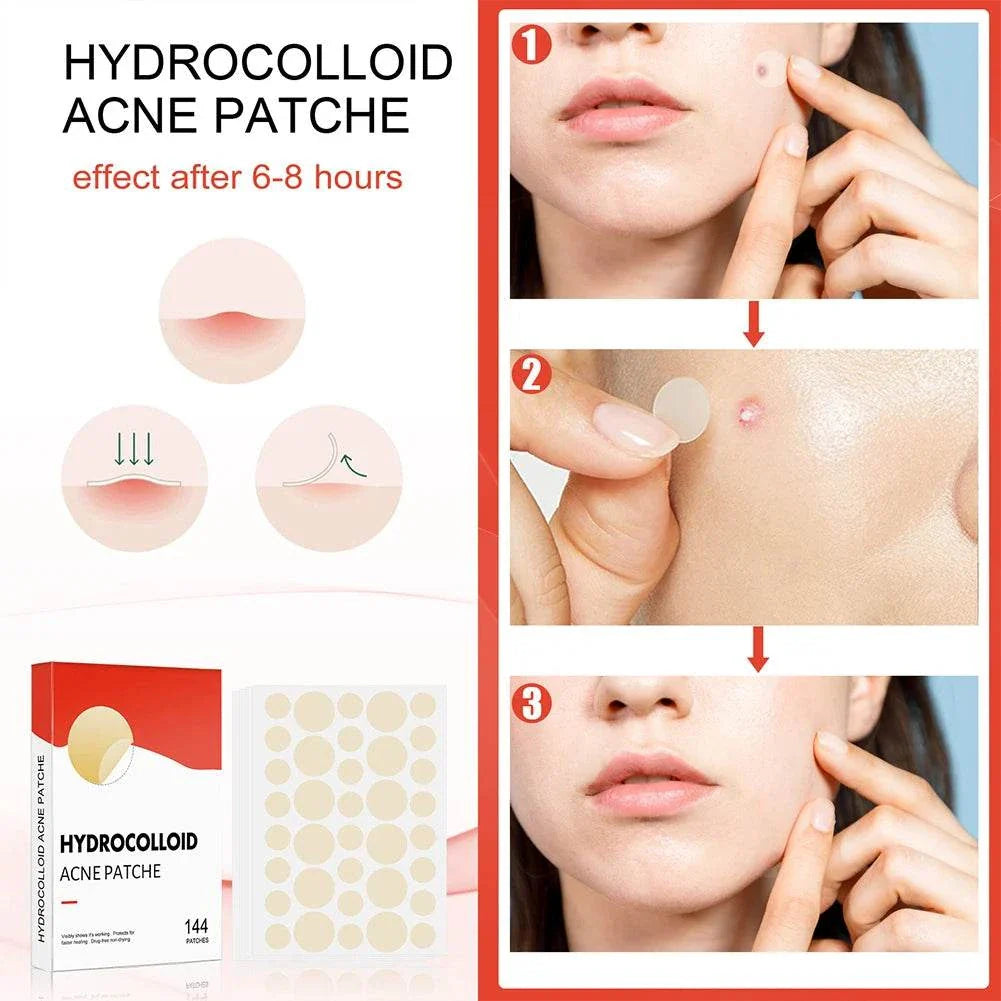 High-End Hydrocolloid acne patches showing application steps and healing effect on facial blemishes