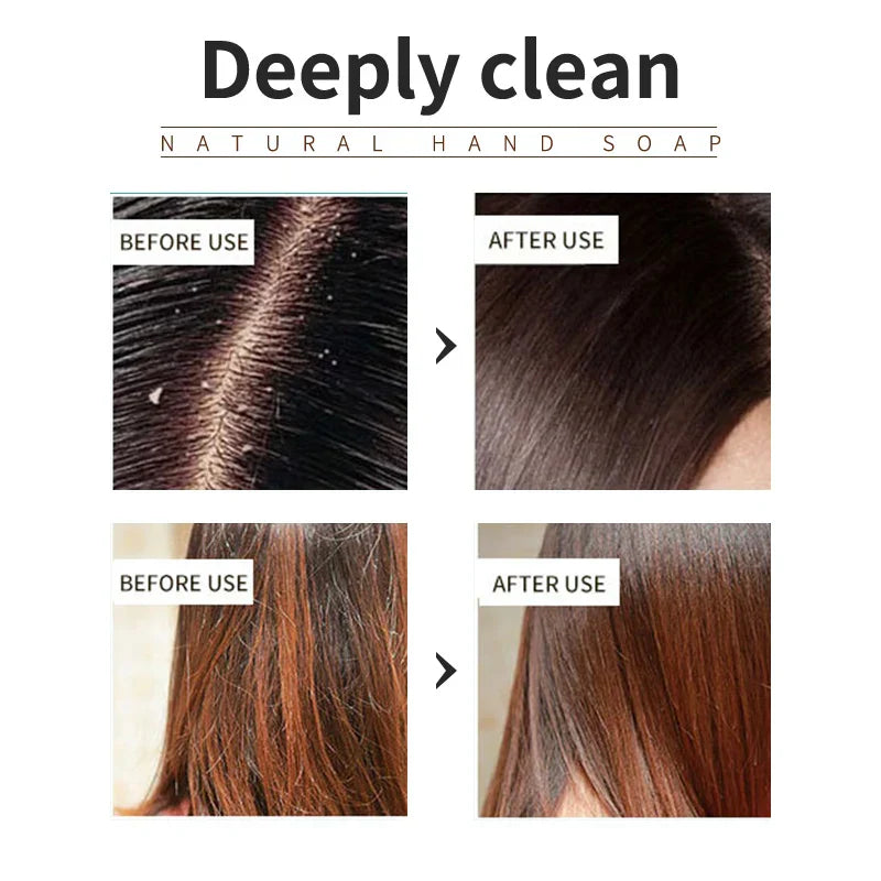 Before and after photos showing scalp and hair oil control with Calendula Plant Shampoo Soap