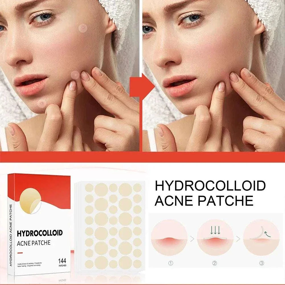 High-end hydrocolloid acne patches for professional healing and spot covering, shown on woman’s face before and after use, with 144-piece patch set packaging.