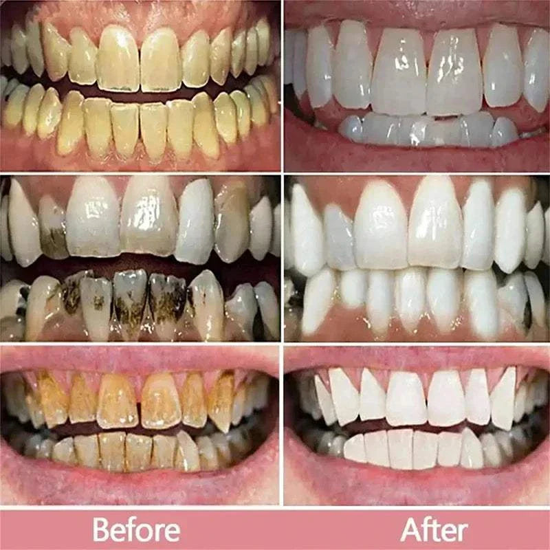 Before and after results of teeth whitening using 5D Teeth Whitening Stick showing significantly brighter and cleaner teeth.