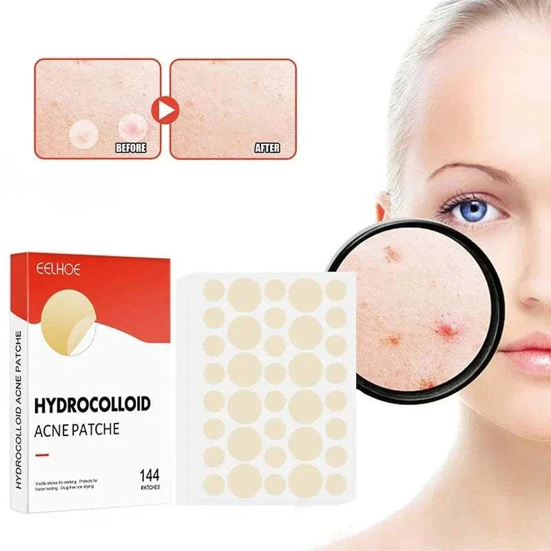 High-end hydrocolloid acne patches set with 144 ultra-thin, invisible healing spots for professional-grade pimple treatment and skin protection.