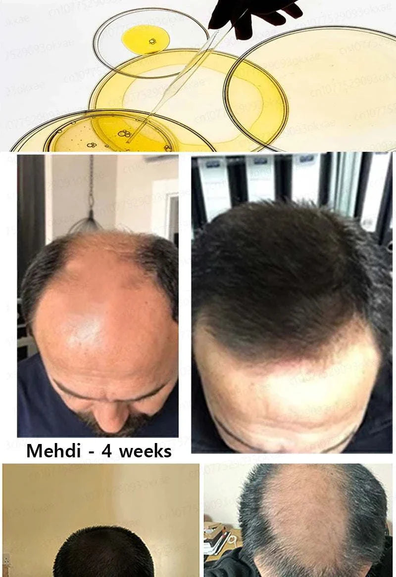 Before and after results of hair growth treatment showing significant improvement in hair density over 4 weeks