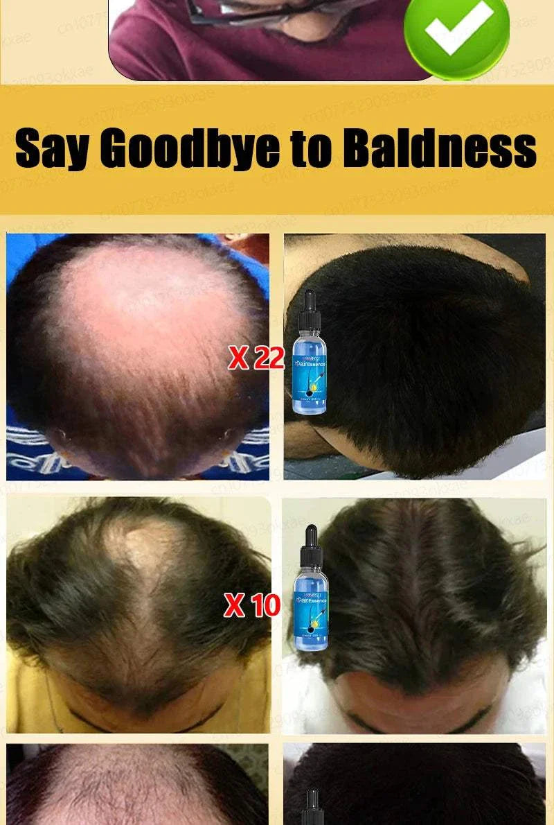 Before and after results of hair growth treatment showing significant reduction in baldness and thicker hair growth