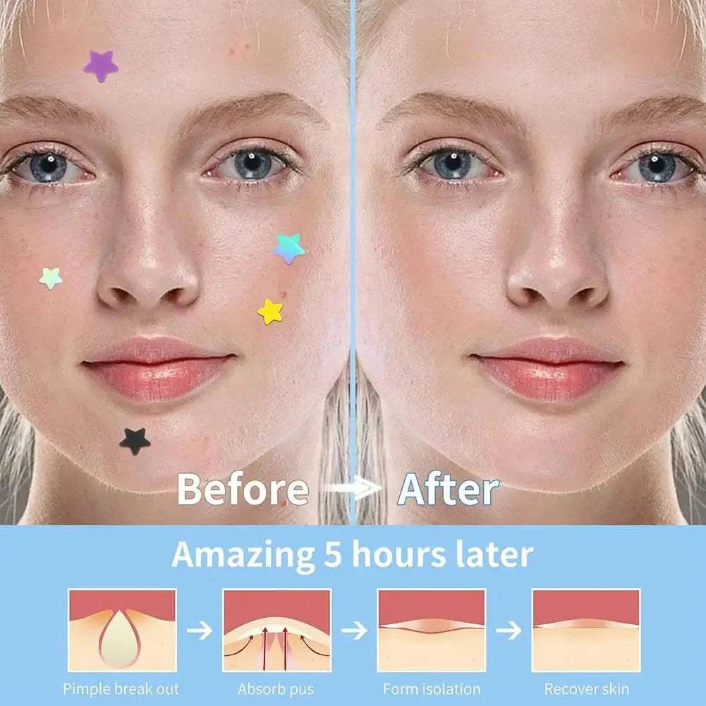 Before and after photo showing clear skin improvement using colorful star-shaped pimple patches that treat and conceal acne effectively