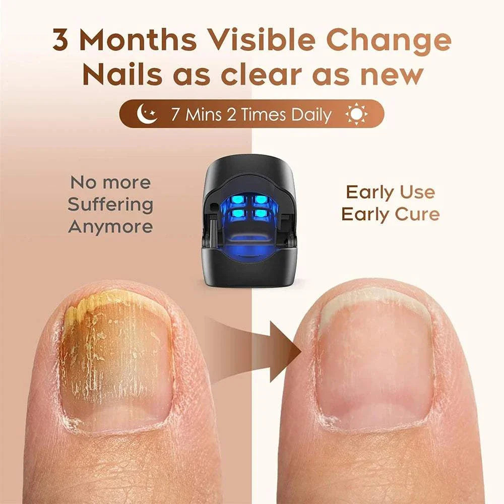Nail Care Device for fungal treatment and nail repair showing before and after results in 3 months with blue light therapy
