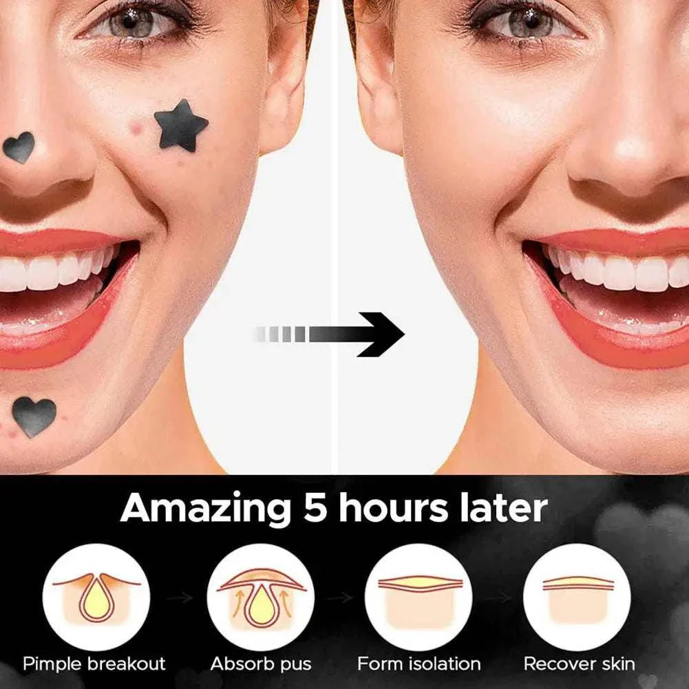 Before and after using Colorful Star Pimple Patch showing acne healing on cheek with star-shaped stickers