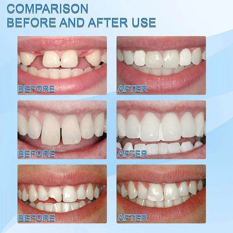 Comparison of teeth before and after using Resin Tooth Repair Glue showing repaired gaps, chipped teeth, and improved smile appearance.