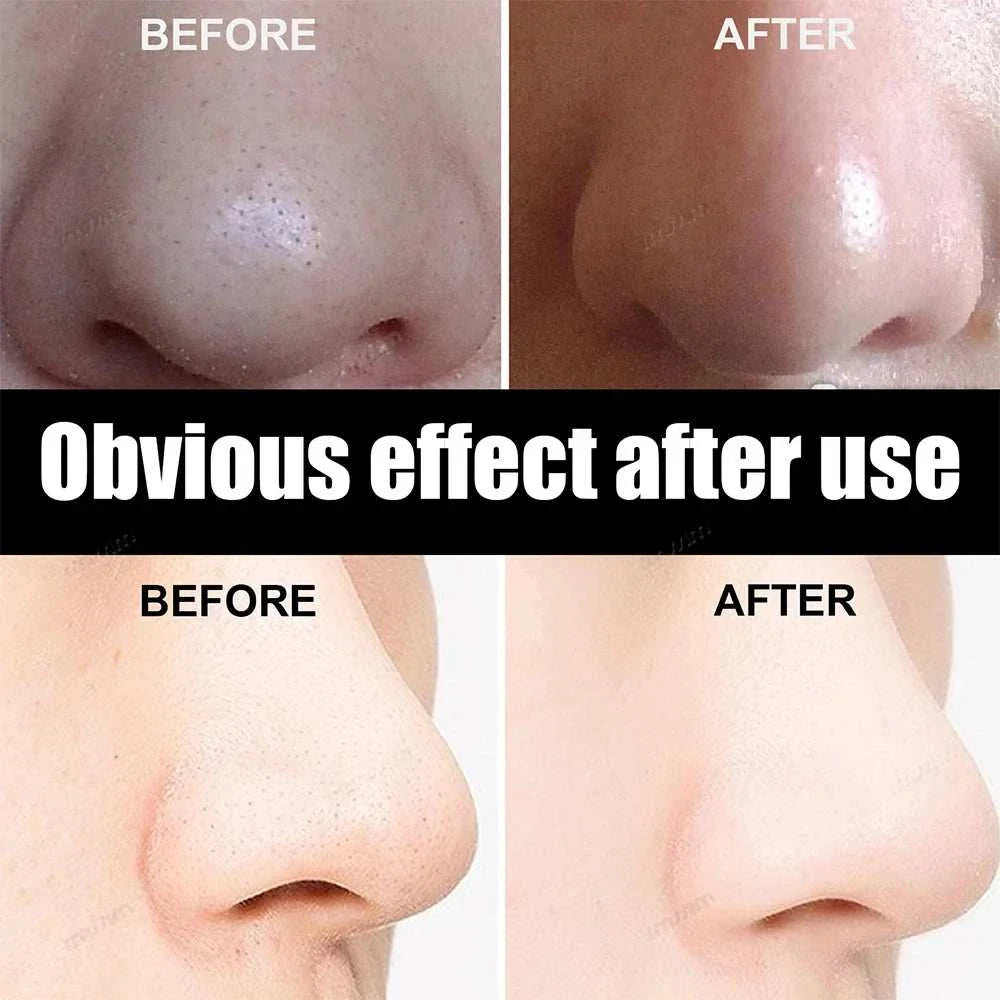 Before and after results showing clearer skin and reduced blackheads using Bamboo Charcoal Nasal Strips for effective pore cleansing and blackhead removal.