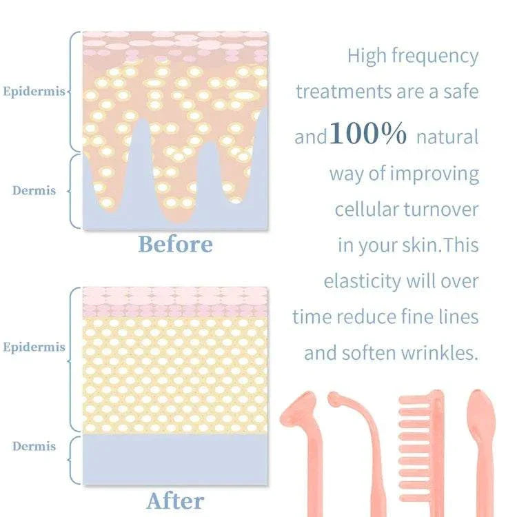 Diagram showing skin layers before and after high frequency treatment with 4-in-1 handheld electric facial therapy wand reducing wrinkles and improving skin elasticity.