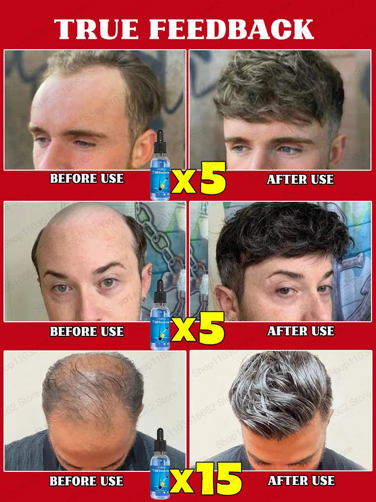 Blue Bottle Hair Growth serum before and after results on balding men showing increased hair density and thickness