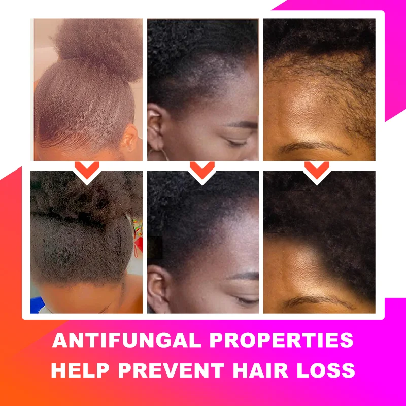 Before and after images showing hair growth and improved scalp health using African Crazy Chebe Hair Oil with antifungal properties to prevent hair loss.