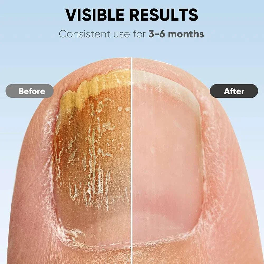 Close-up comparison of toenail before and after using nail care device showing fungal treatment and nail repair results over 3-6 months