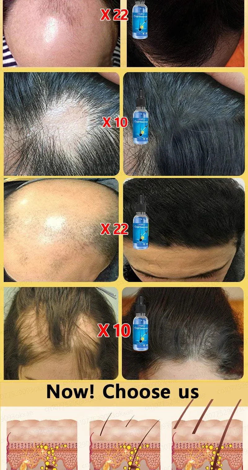 Before and after images showing significant hair regrowth using a hair growth treatment product with visible improvement on thinning and balding areas.