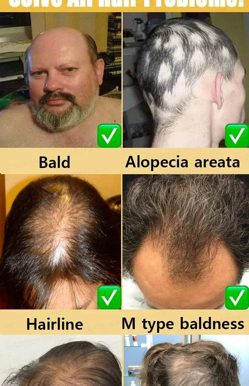 Before and after images showing different hair loss conditions treated by hair growth treatment including baldness, alopecia areata, receding hairline, and M type baldness