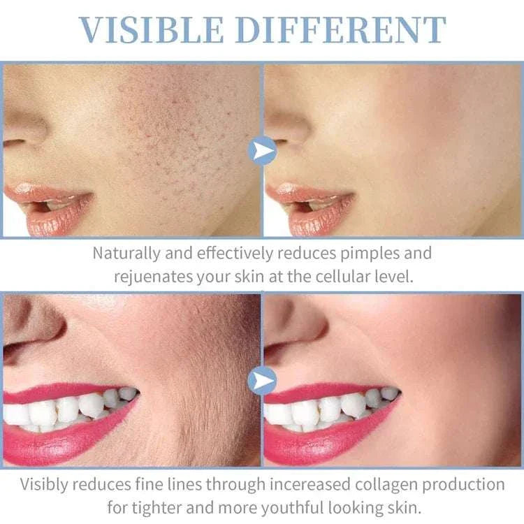 4-in-1 Handheld Electric Facial Therapy Wand showing before and after results for reduced pimples, fine lines, and rejuvenated skin