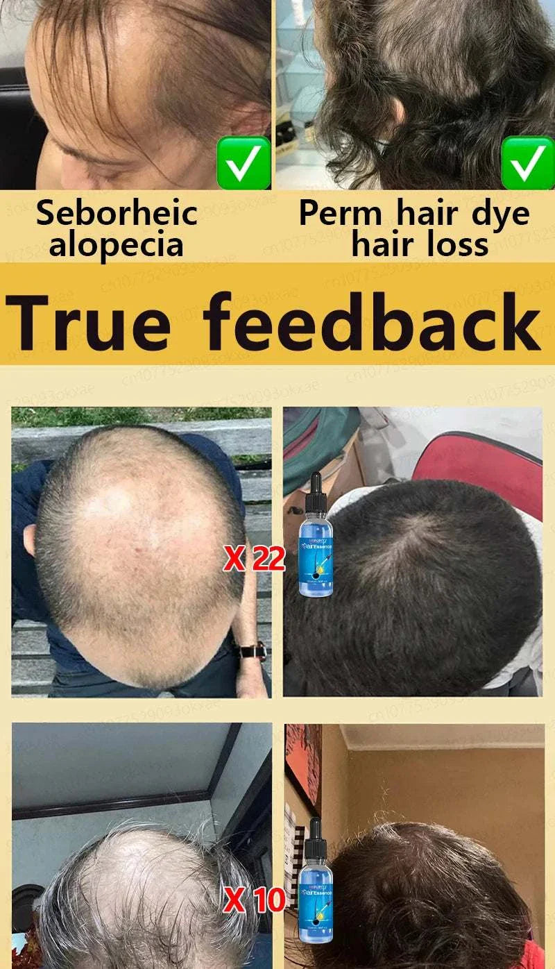 Before and after results of hair growth treatment showing improved hair density and reduced hair loss in cases of seborrheic alopecia and perm hair dye damage.