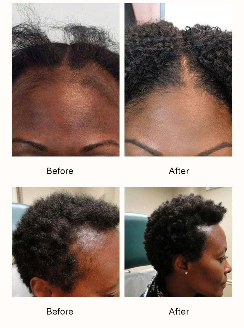 Before and after photos showing hair regrowth and improved hair density using African Crazy Chebe Hair Oil