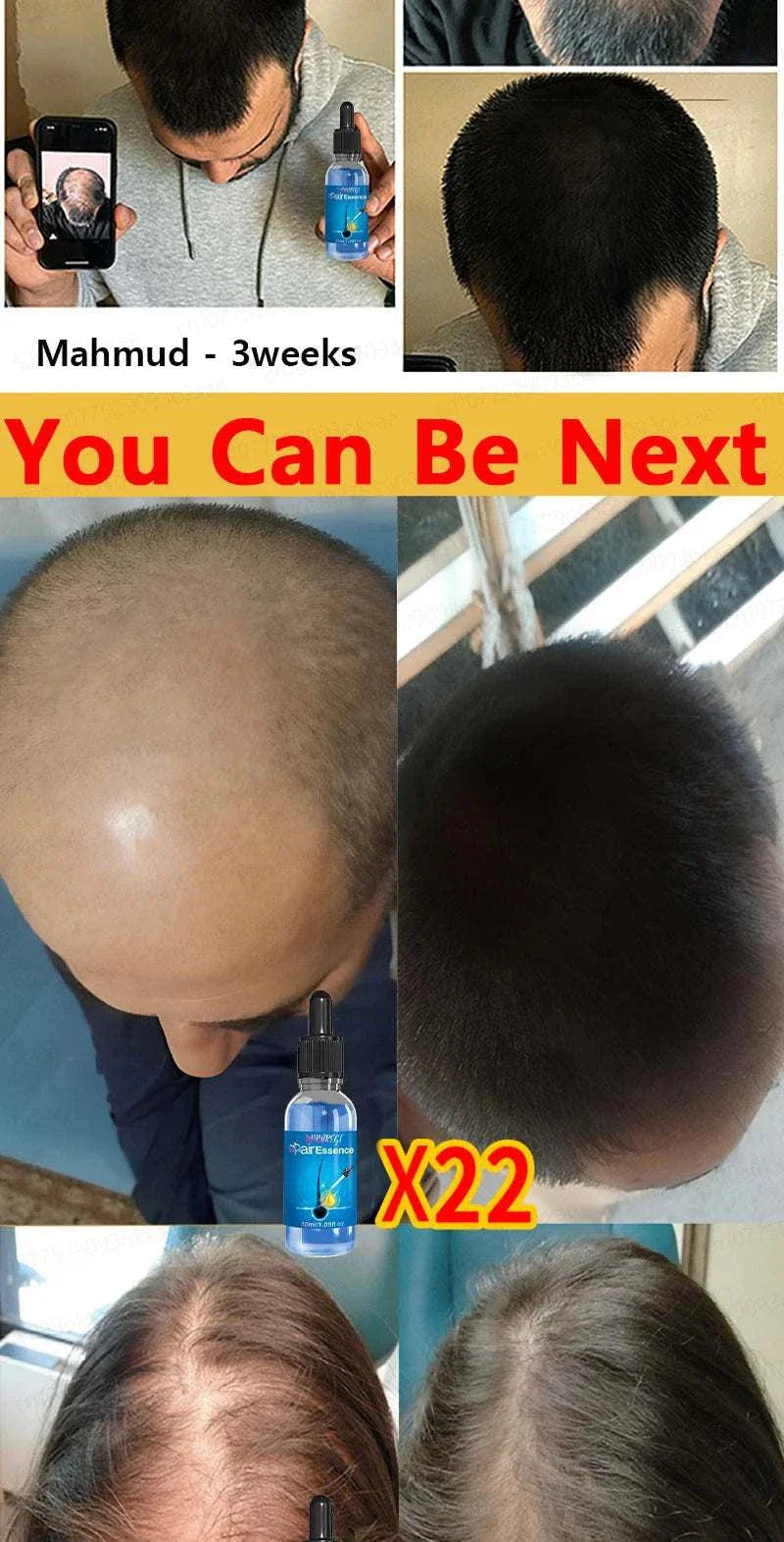 Before and after photos showing hair regrowth results after using Hair Growth Treatment for three weeks and 22 applications.