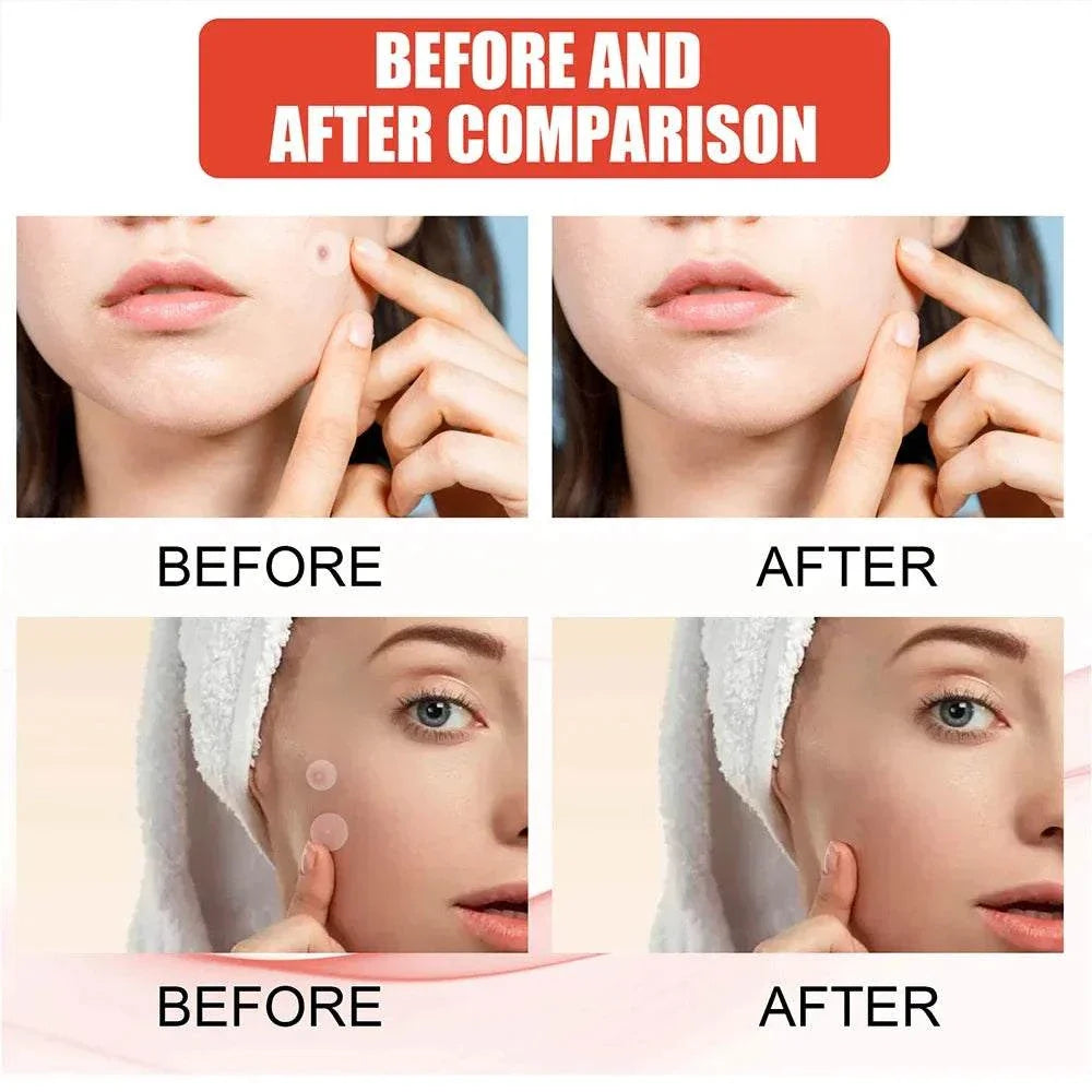 Before and after comparison of high-end acne patches showing reduced blemishes and clearer skin.